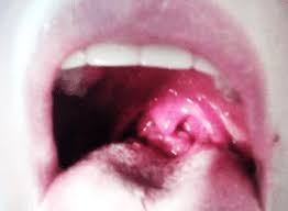 Pasha may consider removing your lingual tonsils if they are determined. Lingual Tonsil Is Dense Tuberous 4 Th Degree Of Hypertrophy Tongue Download Scientific Diagram