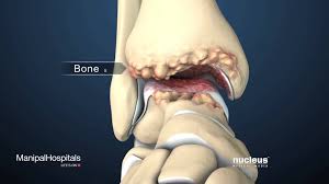 Total Ankle Replacement Surgery For Arthritis Manipal Hospital Watch Video Here Http Arthritisreme Knee Arthritis Ankle Replacement Yoga For Arthritis