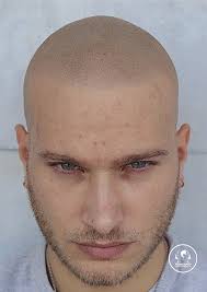 Di dover smettere le cure volta eseguita la micro pigmentazione. Guida Alla Tricopigmentazione Cos E Foto Benefici Durata Prima E Dopo