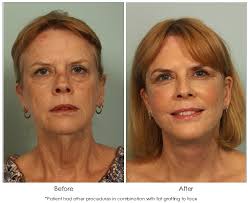 Patricia chavez and pedro s. Fat Grafting El Paso Fat Injections El Paso Cosmetic Surgery