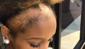 However, it is a myth that it is believed that braiding for a long time actually changes the rate or cycle of hair growth. This Woman S Honesty About Her Hair Loss Will Make You Think Twice About Your Style Self