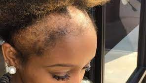 Your hairstyle does not determine the growth rate. This Woman S Honesty About Her Hair Loss Will Make You Think Twice About Your Style Self