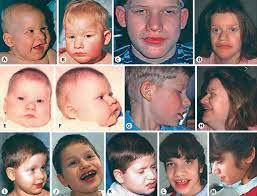 Facial Features Of Patients With Tcf4 Related Pitt Hopkins Syndrome Download Scientific Diagram