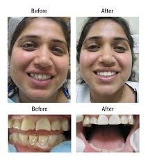 Start with these basic guidelines from webmd. Cosmetic Dentistry Azusa Cosmetic Care