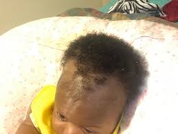 In the first six months after birth, a child will lose what is known as birth hair. Baby Hair Loss African American Mommies Forums What To Expect