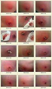 Some people are slightly affected by the venom, but others the first symptom is acute pain at the site of the bite though there may only be a minimal local reaction. 22 Brown Recluse Spider Ideas Brown Recluse Brown Recluse Spider Recluse Spider