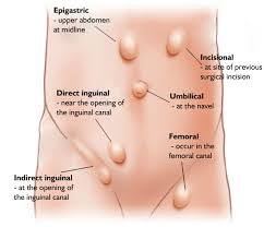 Inguinal Hernia Anatomy In Female Hernia Repair Teeth To Toe Hernia Symptoms Hernia Repair Abdominal Hernia