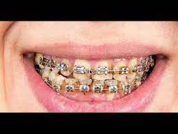 You may also feel some general pain when you chew anything at all. What Happens When You Have Braces And Cavities Https Www Straightsmilesolutions Com Youtube