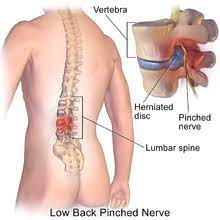 We would like to show you a description here but the site won't allow us. Spinal Disc Herniation Wikipedia