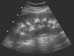 Medullary Sponge Kidney Ultrasound Google Search Medullary Sponge Kidney Ultrasound Renal Disease