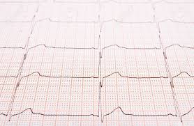 Heart Rhythm Chart For Background Usage