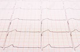 Heart Rhythm Chart For Background Usage