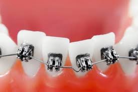 Temporary tooth repair kit diy false teeth fix broken gaps filling denture solid gel αγοράστε σε χαμηλές τιμές στο κατάστημα joom. Diy Dental Care That Is Actually Bad For You The Dental Studio