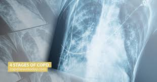 Image result for COPD Staging