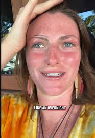 Thailand Sunburn