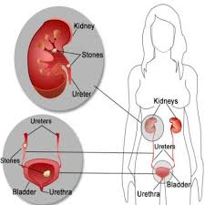 15 Valuable Home Remedies For Kidney Stones Http Ekidneystones Com Kidney Stones Kidney Stones Remedy Kidney Disease Symptoms