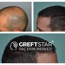 Pin Af Greft Star Pa Sac Ekimi Samsun