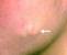 Cystic Bum Acne