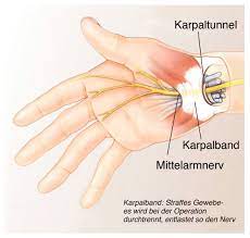 Karpaltunnelsyndrom Wenn Es Den Nerven Zu Eng Wird Klinikum Landsberg Am Lech