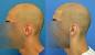 Scalp Micropigmentation Regrets