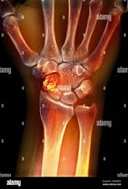 Image result for Wrist XRay