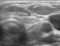 Cysts or abnormal growths in the liver, spleen, or pancreas. Why Thyroid Surgeons Are Frustrated With Radiologists Lessons Learned From Pre And Postoperative Us Radiographics