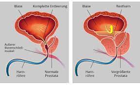 Prostata Symptome Traduzione Riguardo Cancro Della Prostata In Transalpino