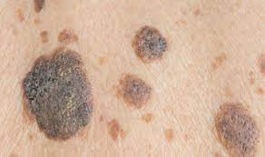 Lentigo maligna accounts for approximately 10% of all melanomas diagnosed by skin cancer clinics and dermatologists in brisbane. Skin Cancer When Your Freckles Could Be A Sign Of The Deadly Condition Express Co Uk