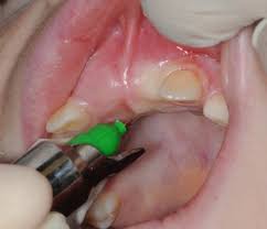 Image result for Periapical Block