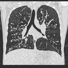This is partly because the lungs are often severely affected and the cause of significant morbidity and mortality. Radiology Bronchiectasis