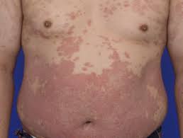 Narrowband Uvb Phototherapy Dermnet Nz