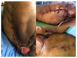 This rare type of gangrene — also called progressive bacterial synergistic gangrene — is usually a complication of. Surgeries Free Full Text Empagliflozin Use And Fournier S Gangrene Case Report And Systematic Literature Review Html