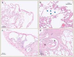 We did not find results for: Cystic Lung Disease Diagnostic Histopathology