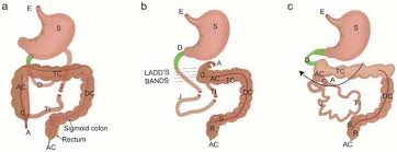 Image result for Midgut Volvulus