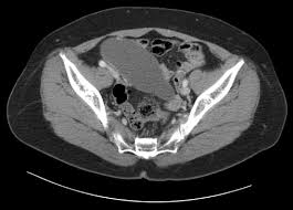 충수돌기염(맹장염) 검사에서 ct의 방사선량을 줄여도(저선량 ct) 진단이 정확하다는 연구결과가 나왔다. Http Www E Jmis Org Journal Download Pdf Php Spage 22 Volume 14 Number 1
