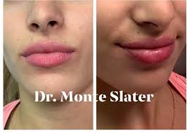 Add definition to your lips with our effective treatments! Restylane Kysse Lip Filler Now Available In Atlanta Warner Robins