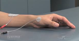 Best Electrode Placement For Arm And Hand Stroke