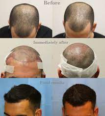 Fue, fut ed ectopico su uomo e donna. Trapianto Dei Capelli Quanto Costa Cosa Aspettarsi