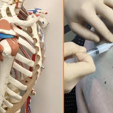 Image result for Subacromial Space Injection