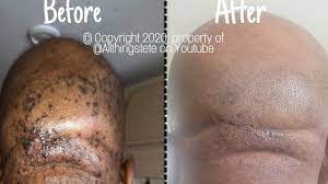 How To Remove Razor Bumps (Easy, Quick And Simple Method!) #Howto - Youtube