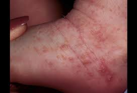 The venomous bite of a black widow spider can be dangerous and the victim should seek medical attention, particularly when extreme reactions are experienced. Scabies 2 Picture Image On Rxlist Com