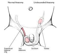 Frey hl, peng s, rajfer j. Cryptorchidism Prof Alessandro Natali