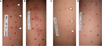 Image result for chancroid