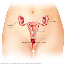 Cancerous lumps tend to be irregular in shape and may feel firm or solid. Vaginal Cancer Symptoms And Causes Mayo Clinic