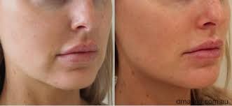 We did not find results for: Dermal Filler For Jowls And Marionette Folds Best Clinic Sydney For Dermal Fillers