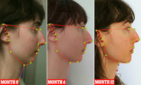 In this condition, your upper teeth protrude over your lower teeth. Mewing Technique Coined By Dr Mike Mew Changes Face Shape Daily Mail Online