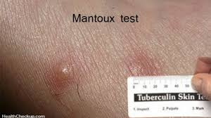 If someone in this group presents post tb skin test at what mm circumference would they be positive: Mantoux Skin Test Procedure Results Interpretation Risks