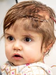 Elena's Journey with a Hairy Nevus