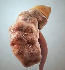Acute renal failure is a syndrome characterized by a sudden decrease of the glomerular filtration rate (gfr) and consequently an increase in blood nitrogen products (blood urea nitrogen and creatinine). Kidney Failure Wikipedia