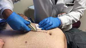 How long do staples stay in place? Abdominal Staple Removal Youtube